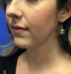 Neck Liposuction case #3842
