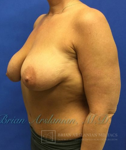 Breast Implants and Lift case #3002