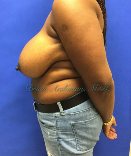 Breast Reduction case #2901