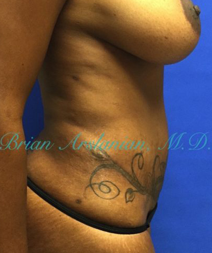 Liposuction case #3588