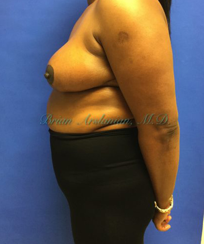 Breast Reduction case #2901