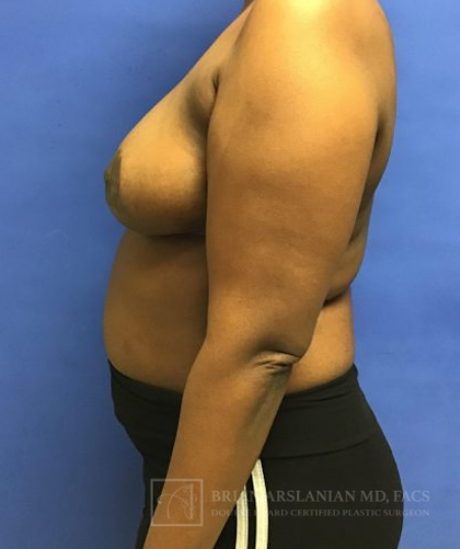 Breast Lift case #2840