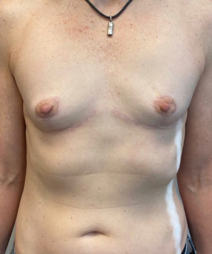 Female To Male case #3458