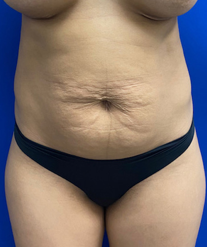 Tummy Tuck case #4022