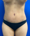 Tummy Tuck case #4022