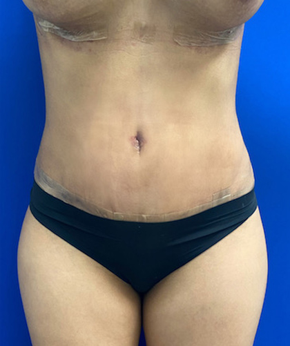 Tummy Tuck case #4022