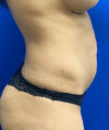 Tummy Tuck case #4022