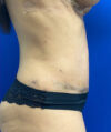 Tummy Tuck case #4022