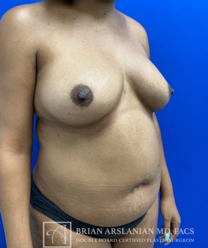 Fat Transfer to the Breasts - American Breast Lift™ ABL case #2485