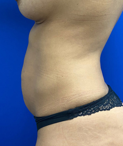 Tummy Tuck case #4022