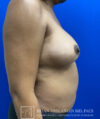 Fat Transfer to the Breasts - American Breast Lift™ ABL case #2485