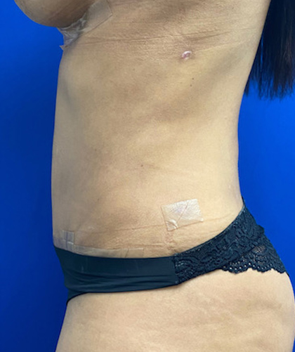 Tummy Tuck case #4022