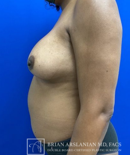 Fat Transfer to the Breasts - American Breast Lift™ ABL case #2485