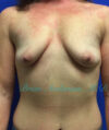 Breast Augmentation case #2497
