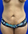 Tummy Tuck case #4029