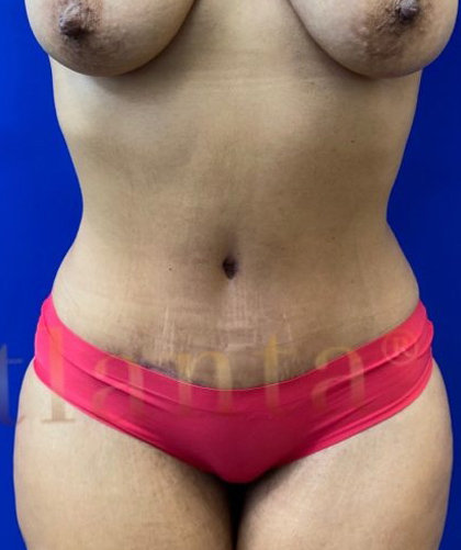 Tummy Tuck case #4029