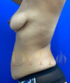 Tummy Tuck case #4029