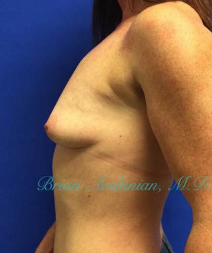 Breast Augmentation case #2497