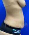 Tummy Tuck case #4029