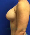 Breast Augmentation case #2497