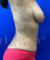 Tummy Tuck case #4029