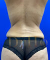 Tummy Tuck case #4029