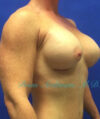 Breast Augmentation case #2497