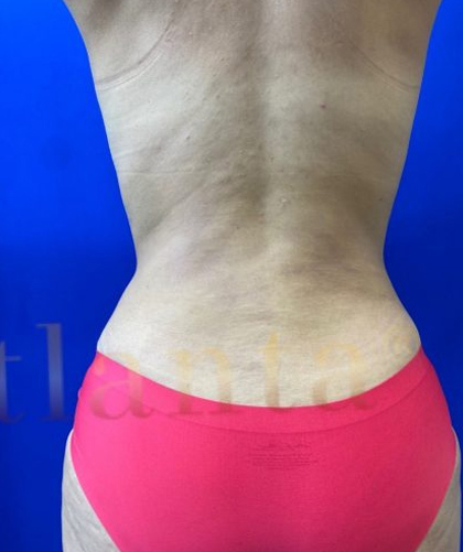 Tummy Tuck case #4029