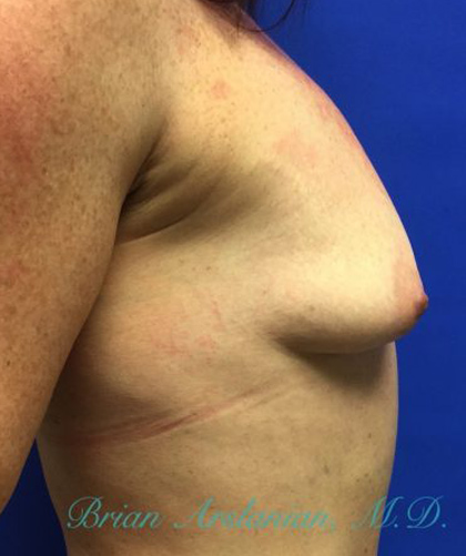 Breast Augmentation case #2497