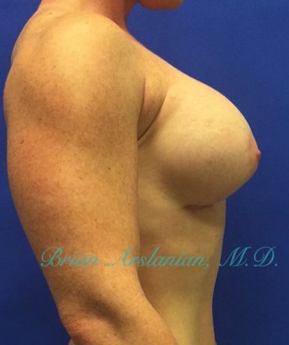 Breast Augmentation case #2497