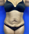 Tummy Tuck case #4049