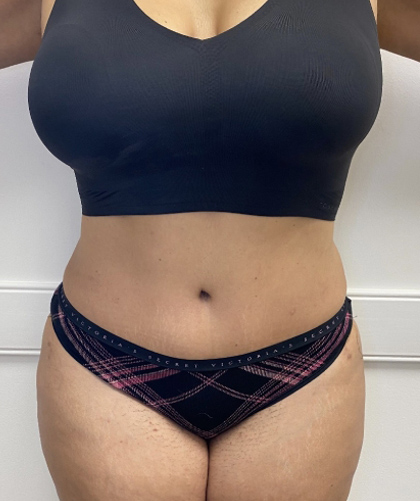 Tummy Tuck case #4049