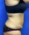 Tummy Tuck case #4049