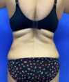 Tummy Tuck case #4049