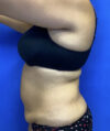 Tummy Tuck case #4049