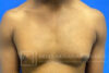 Gynecomastia case #4222