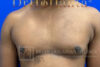 Gynecomastia case #4222