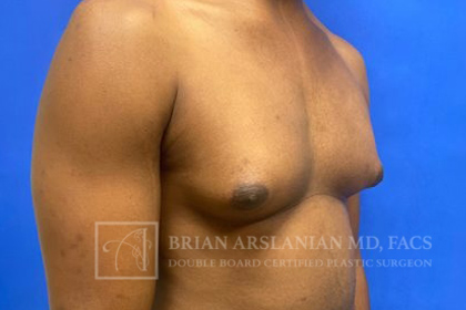 Gynecomastia case #4222