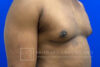 Gynecomastia case #4222