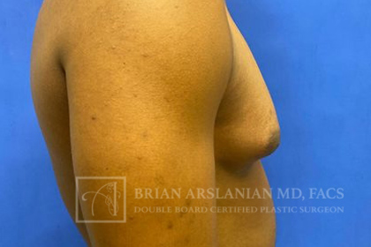 Gynecomastia case #4222