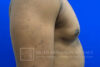 Gynecomastia case #4222