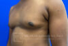 Gynecomastia case #4222