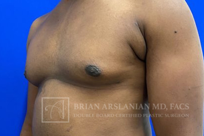 Gynecomastia case #4222