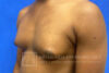 Gynecomastia case #4222