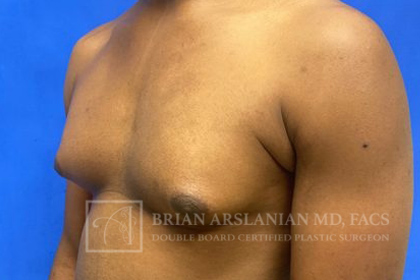 Gynecomastia case #4222