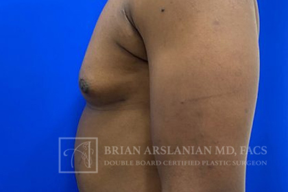 Gynecomastia case #4222