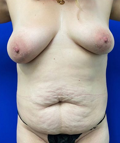 Breast Lift case #4385