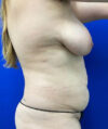 Breast Lift case #4385