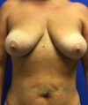 Breast Lift case #4235