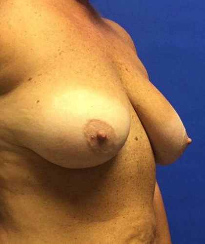 Breast Lift case #4235
